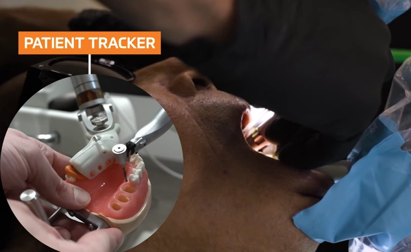 หุ่นยนต์ฝังรากฟันเทียม ช่วยผ่าตัดแม่นยำ ไม่ต้องผ่าเหงือก