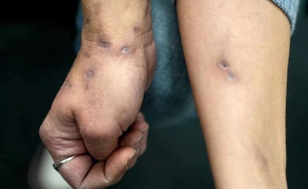 โลกร้อนปลุกแบคทีเรียกินเนื้อ กำลังระบาดในสหรัฐฯ แค่รอยข่วนก็เสี่ยงเสียชีวิต!