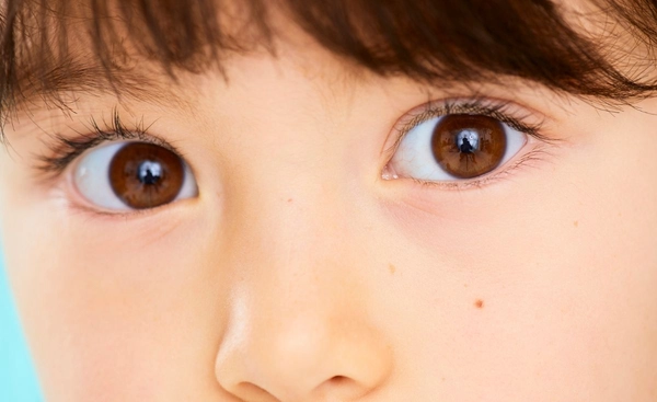 รู้หรือไม่ เด็กเล็กมีปานแดง-ดำ พาดผ่านดวงตาอาจเสี่ยงเป็นโรคต้อหิน