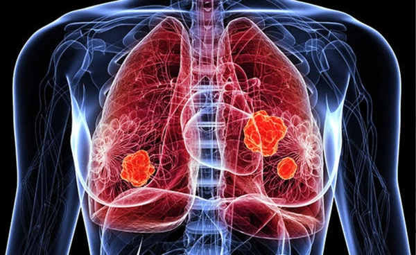 ข่าวดี ผู้ป่วยมะเร็งปอดเบิกยามุ่งเป้า Erlotinib - Gefitinib ได้แล้ว ยับยั้งมะเร็งได้ถึง 1 ปี