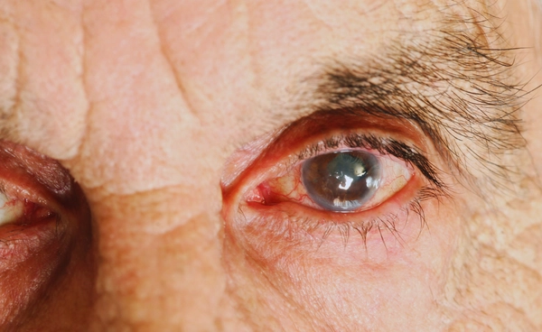 นักวิจัยทดลองยาหยอดยารักษาโรคต้อกระจก