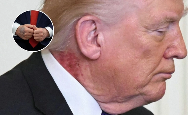 รอยแผลบนตัวทรัมป์ ข่าวลือที่ยังเป็นปริศนา