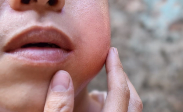 ผู้ใหญ่ วัยรุ่น ป่วยคางทูมเพิ่ม ป่วยสะสม 1900 ราย