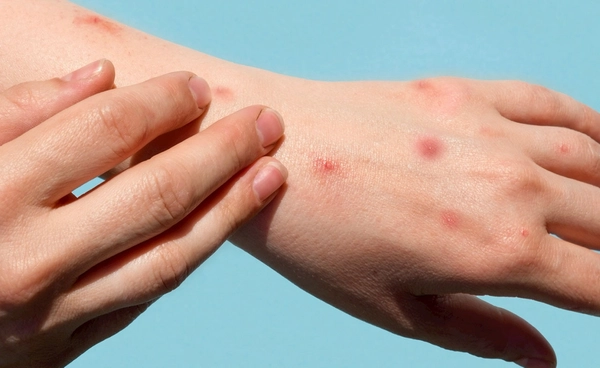 วาเลนไทน์ 2569 ตรวจสุขภาพทางเพศฟรี เตือนสถิติซิฟิลิสพุ่ง 3 เท่า 