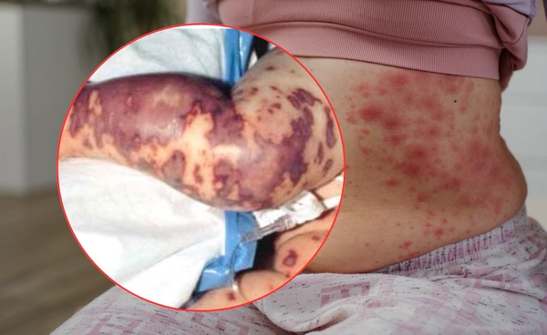 ไข้กาฬหลังแอ่นในประเทศไทย พบได้บ่อยแค่ไหน?