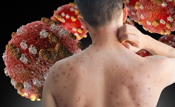 โรคหัดระบาดหนักในสหรัฐฯ ป่วย 2,000 ราย ไทยเฝ้าระวังใกล้ชิด