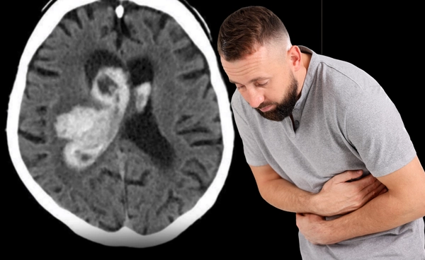 เคสชายวัย 62 ปี เบ่งอุจจาระแรง จนล้มตึงคาห้องน้ำ ตรวจพบเลือดออกกลางสมอง