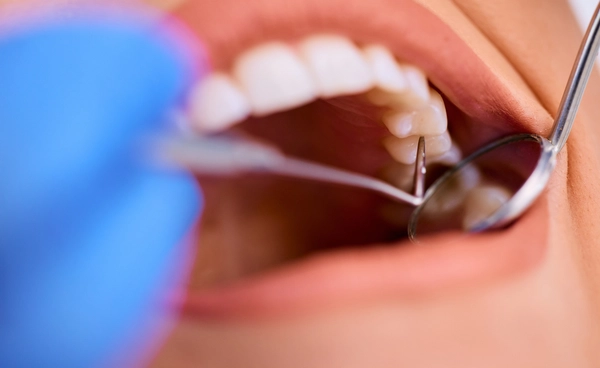 "ขูดหินปูน" ทำไมต้องทำทุกปี เรื่องควรรู้ก่อนเกิดโรคแทรกซ้อน สูญเสียฟันในอนาคต