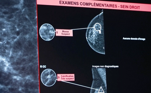 ฝรั่งเศสใช้ AI “คัดกรองมะเร็งเต้านม” พบแม่นยำขึ้น ช่วยลดภาระแพทย์