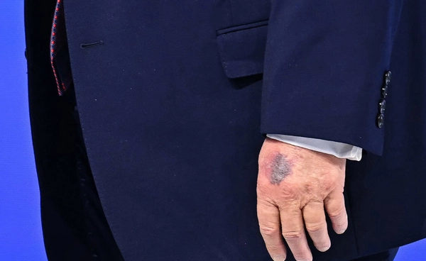 ทรัมป์เผยรอยแผลที่มือเพราะชนโต๊ะระหว่างลงนาม Board of Peace ร่วมกับเขากินยาแอสไพริน 