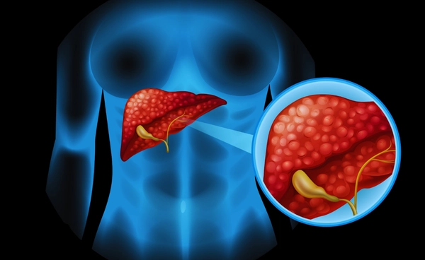 น้ำตาลทำร้ายตับ ได้ไม่ต่างจากการดื่มเหล้า