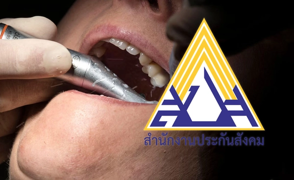 อัปเดต ทำฟันประกันสังคม 2569 : เพิ่มสิทธิ อุดฟัน - ผ่าฟันคุด - รากฟันเทียม เริ่ม 1 พ.ค. 