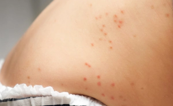 ระวัง! "โรคอีสุกอีใส" ตั้งแต่ต้นปีพบผู้ป่วยสะสมพุ่ง 10,560 ราย เช็กอาการ-การป้องกัน