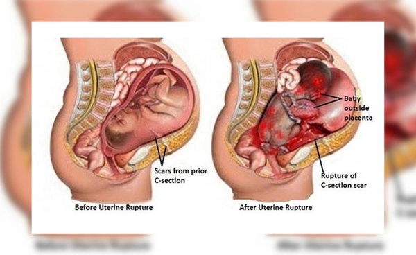 ภาวะมดลูกแตก อันตรายถึงชีวิต แม่–ลูกเสี่ยงสูง ใครคือกลุ่มเสี่ยง