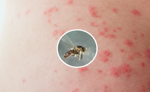 "คุ่นกัด"อันตรายแค่ไหน? แพทย์ไขข้อสงสัย ใช่สาเหตุเสียชีวิตโดยตรงหรือไม่?