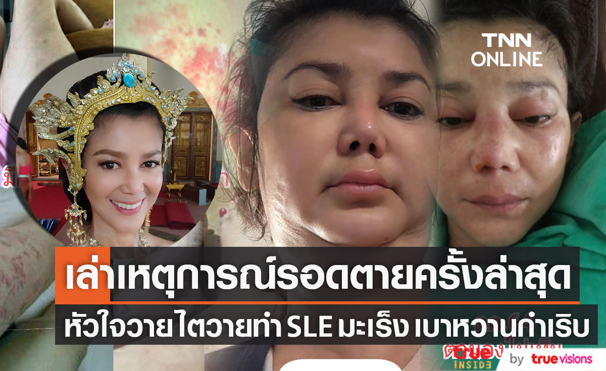 รอดตายครั้งล่าสุด!! อดีตดารา "เอ๋ อัจฉรา" หัวใจ-ไตวายเฉียบพลัน ทำ SLE มะเร็ง เบาหวานกำเริบ