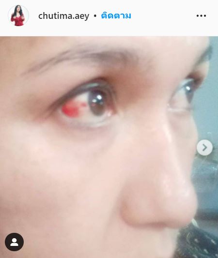 เกิดอุบัติเหตุ!! เอ้ ชุติมา รถเบรกกะทันหัน เล็บทิ่มลูกตา