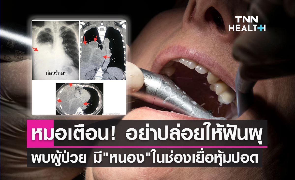 "ฟันผุ" ต้องระวัง! "หมอมนูญ"เปิดผลเอกซเรย์ผู้ป่วย พบหนองในช่องเยื่อหุ้มปอด