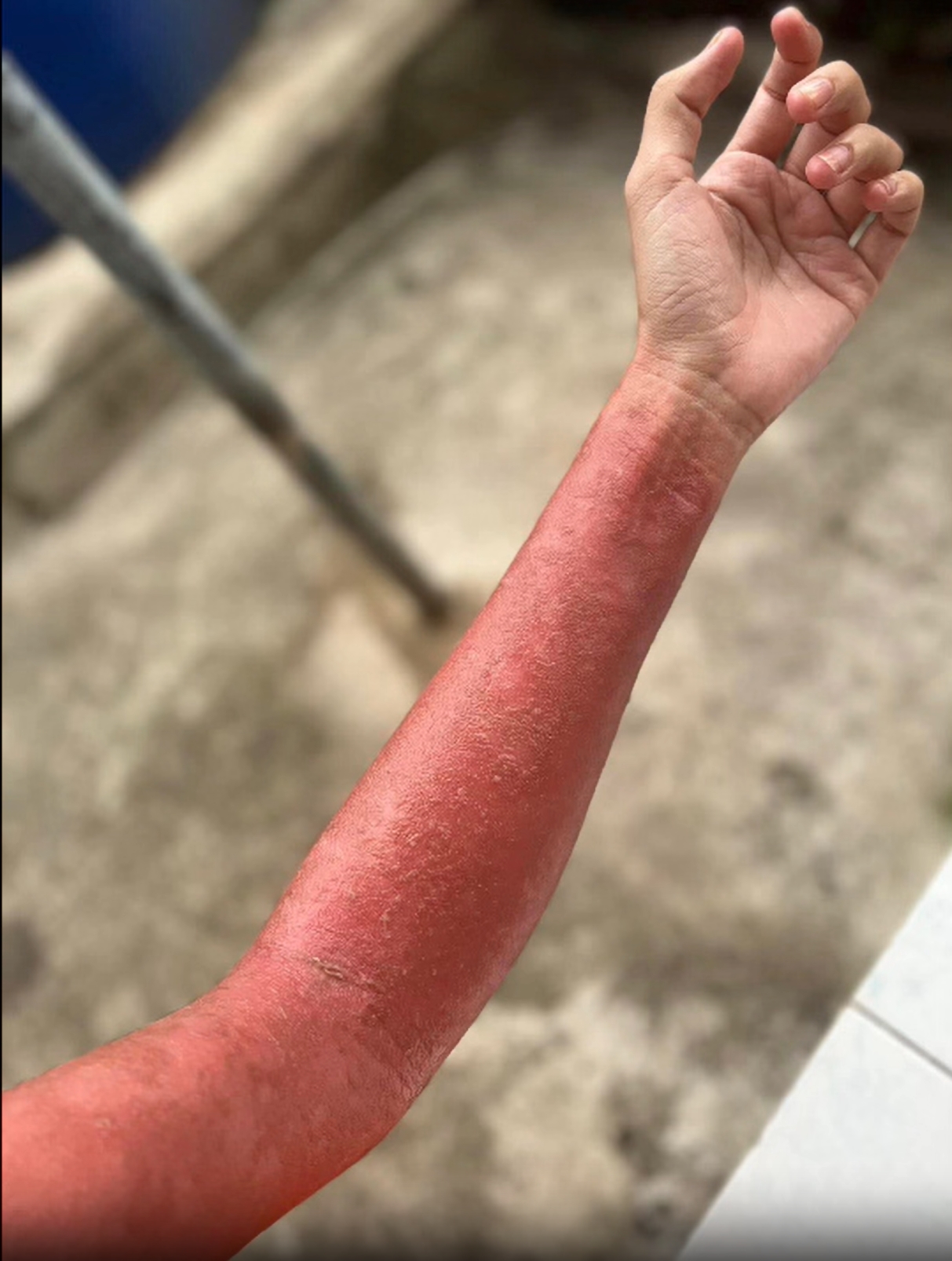 ความเสี่ยงที่ทำให้เกิด โรคพุ่มพวง หรือ โรคแพ้ภูมิตัวเอง 