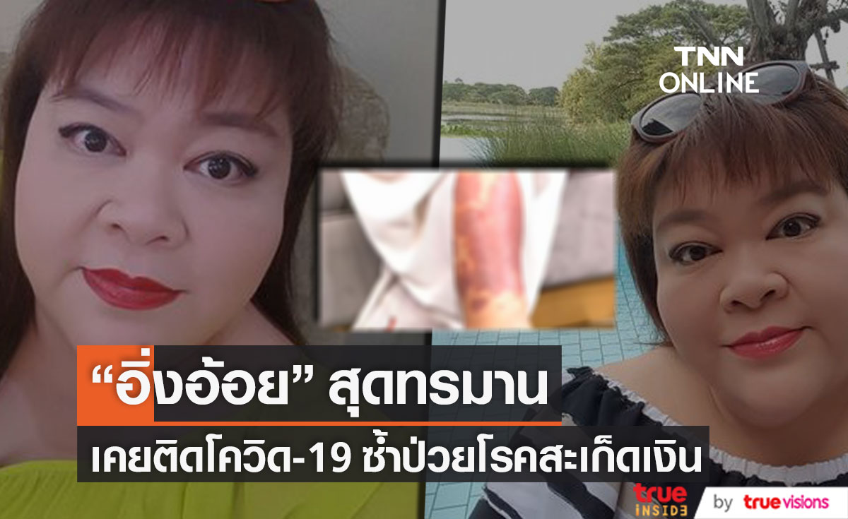 สุดทรมาน!! "อิ่งอ้อย สิทธิวดี" เคยติดโควิด-19 ซ้ำป่วยโรคสะเก็ดเงิน