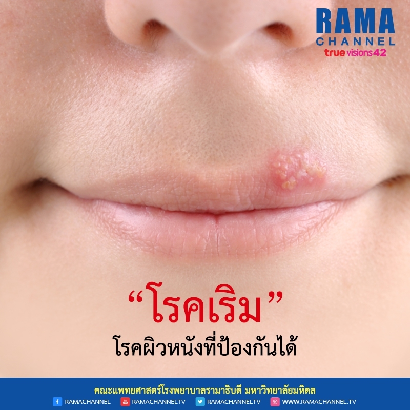 ความแตกต่างของ โรคฝีดาษลิง กับ โรคเริม ความแตกต่างของ โรคฝีดาษลิง กับ โรคเริม