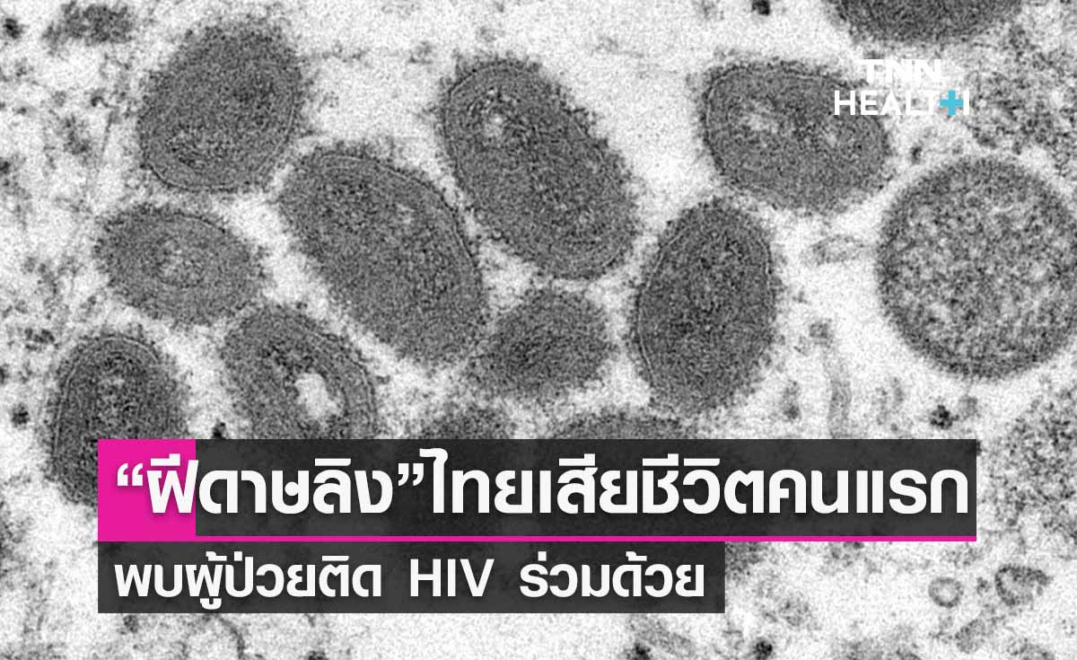 ไทยเสียชีวิตรายแรกจาก “ฝีดาษลิง” พบผู้ป่วยติด HIV ร่วมด้วย