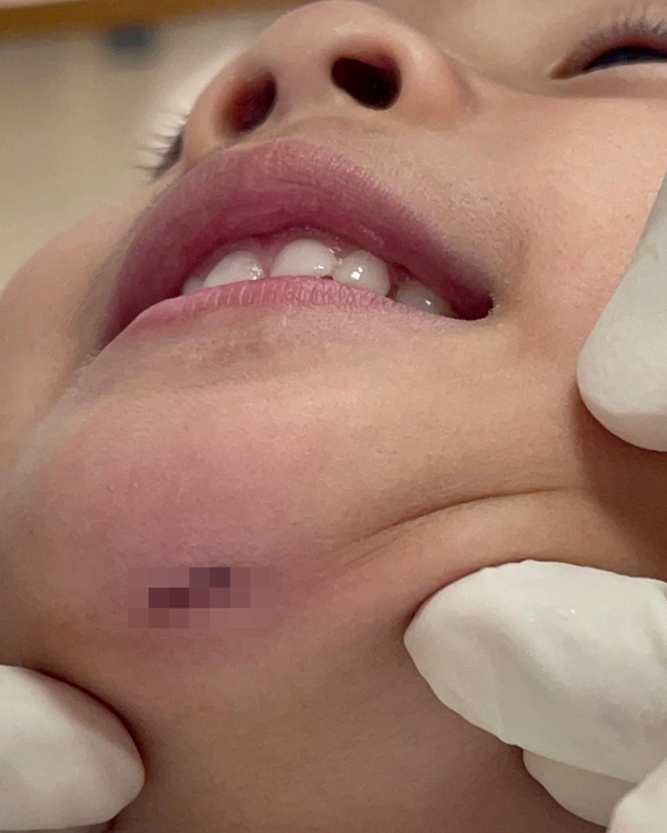 กุ๊บกิ๊บ ใจหล่น!! เป่าเปา ล้มคางแตกเย็บ 4 เข็ม! กุ๊บกิ๊บ ใจหล่น!! เป่าเปา ล้มคางแตกเย็บ 4 เข็ม!