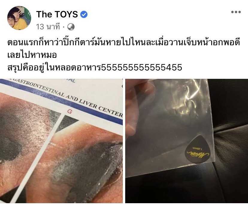 เดอะทอยส์ เจ็บหน้าอก ไปหาหมอแล้วเจอปิ๊กกีต้าร์ที่หายไปในหลอดอาหาร