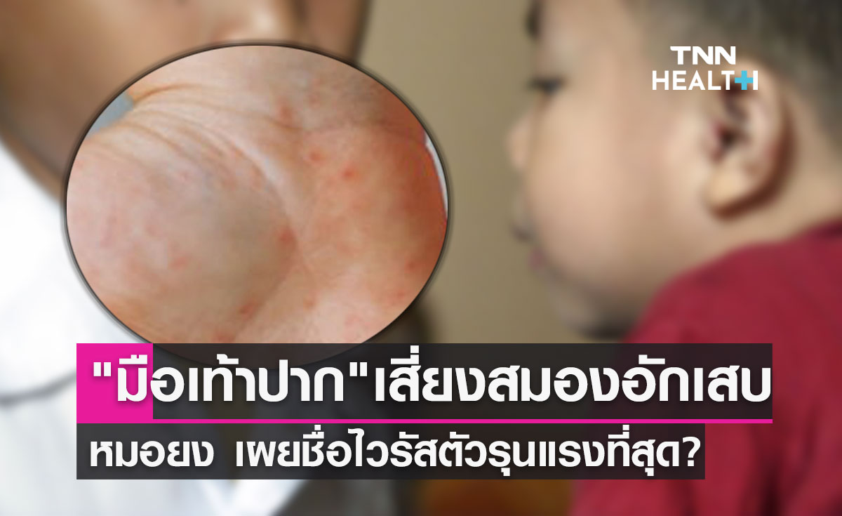 "โรคมือเท้าปาก" หมอยง เผยชื่อไวรัสตัวรุนแรงที่สุด? เสี่ยงสมองอักเสบ