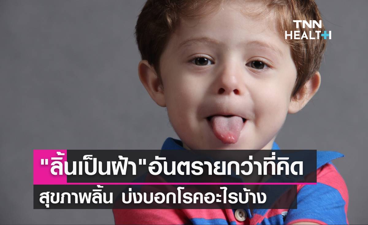 "ลิ้นเป็นฝ้า" ปัญหาสุขภาพช่องปากที่ไม่ควรมองข้าม
