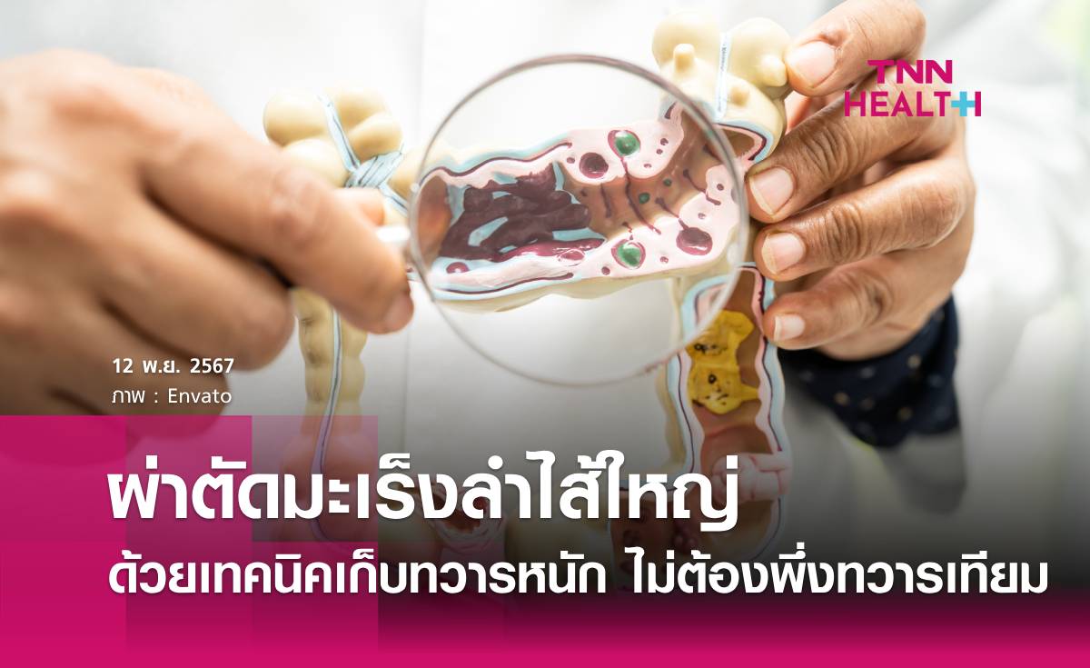 ผ่าตัดมะเร็งลำไส้ใหญ่ ด้วยเทคนิคเก็บทวารหนัก ไม่ต้องพึ่งทวารเทียม