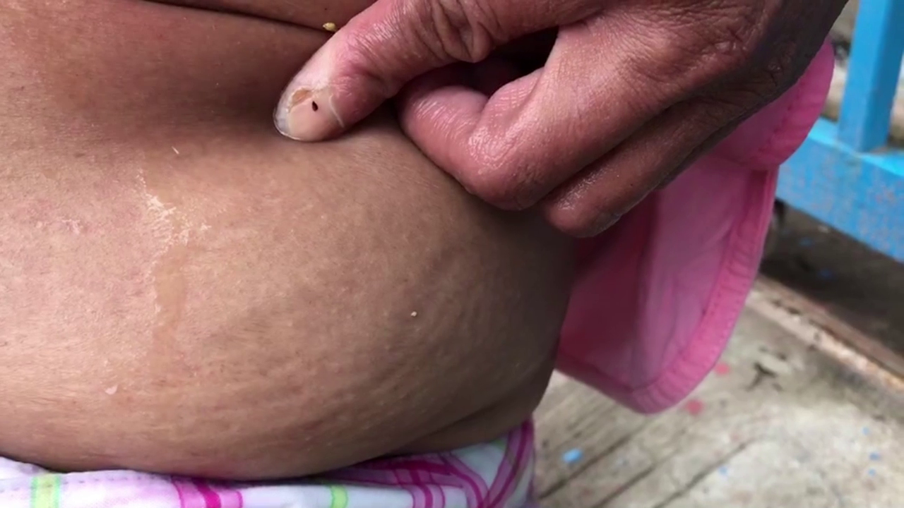 สาวใหญ่ป่วยโรคประหลาด! คล้ายหนอนโผล่ออกมาตามผิวหนัง สาวใหญ่ป่วยโรคประหลาด! คล้ายหนอนโผล่ออกมาตามผิวหนัง