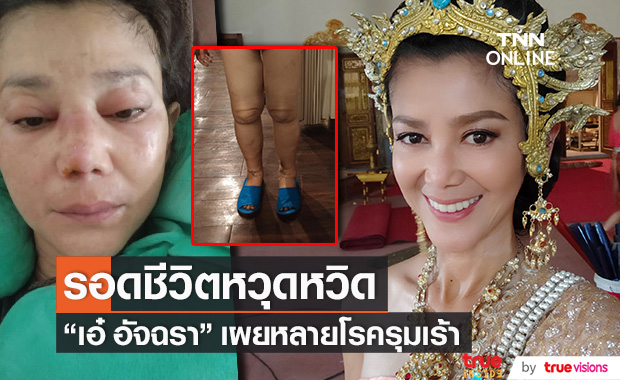 อดีตดารา "เอ๋ อัจฉรา" รอดชีวิตหวุดหวิด!! ป่วยหลายโรครุมเร้า
