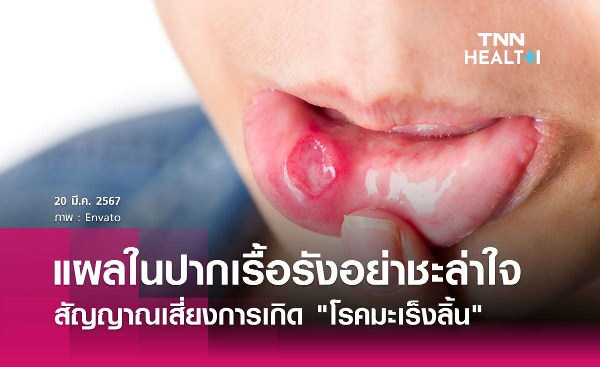 เกิดแผลเรื้อรังอย่าชะล่าใจ สัญญาณเสี่ยงการเกิด"โรคมะเร็งลิ้น"