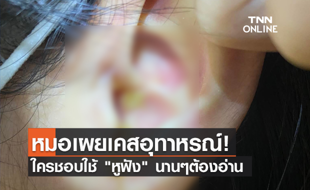 เคสอุทาหรณ์ หมอเตือนใครใช้ "หูฟัง" นานๆระวังมีอาการแบบนี้?