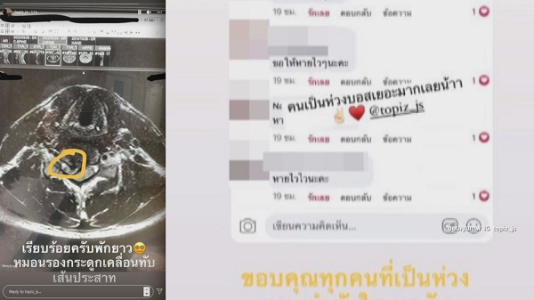 “ท็อป จรณ” กังวล หวั่นเป็นอัมพฤกษ์ ถ้าไม่ดีขึ้นต้องผ่าตัด  (มีคลิป)