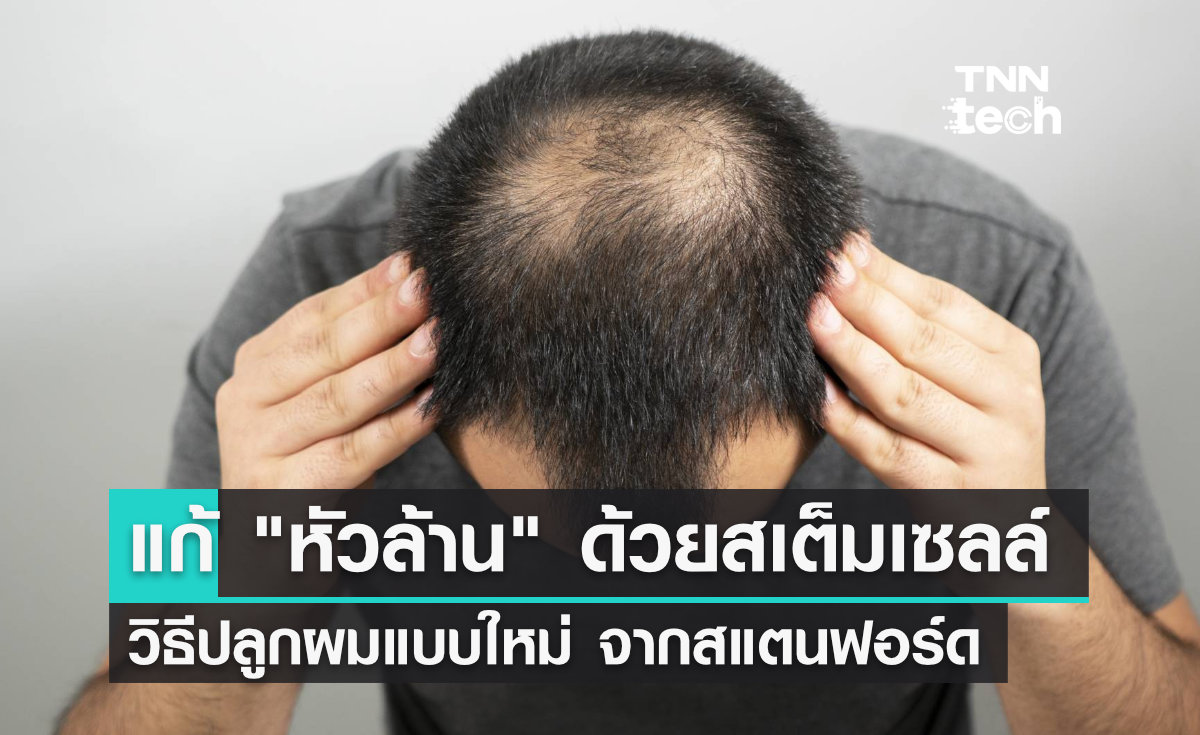 นักวิจัยจากสแตนฟอร์ด คิดค้นวิธี "ปลูกผม" แก้ปัญหาหัวล้านด้วยสเต็มเซลล์