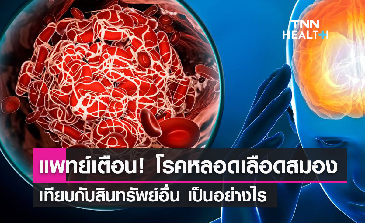 แพทย์เตือนโรคหลอดเลือดสมองโป่งพองแตก อันตรายพิการถึงเสียชีวิต