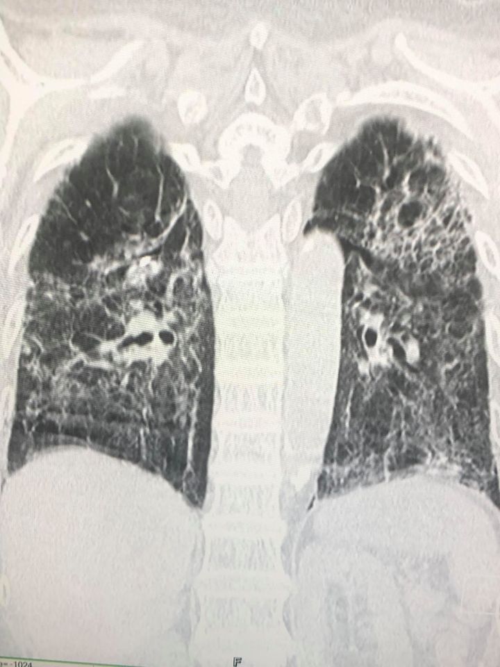 หมอมนูญ เปิดภาพเอ็กซเรย์ปอดผู้ป่วยโควิด ยังไม่ได้ฉีดวัคซีน ปอดรั่วทั้ง 2 ข้าง หมอมนูญ เปิดภาพเอ็กซเรย์ปอดผู้ป่วยโควิด ยังไม่ได้ฉีดวัคซีน ปอดรั่วทั้ง 2 ข้าง