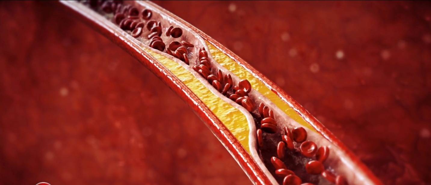 ใจสั่น ประจำเดือนน้อย เสี่ยงหัวใจขาดเลือด ? ใจสั่น ประจำเดือนน้อย เสี่ยงหัวใจขาดเลือด ?