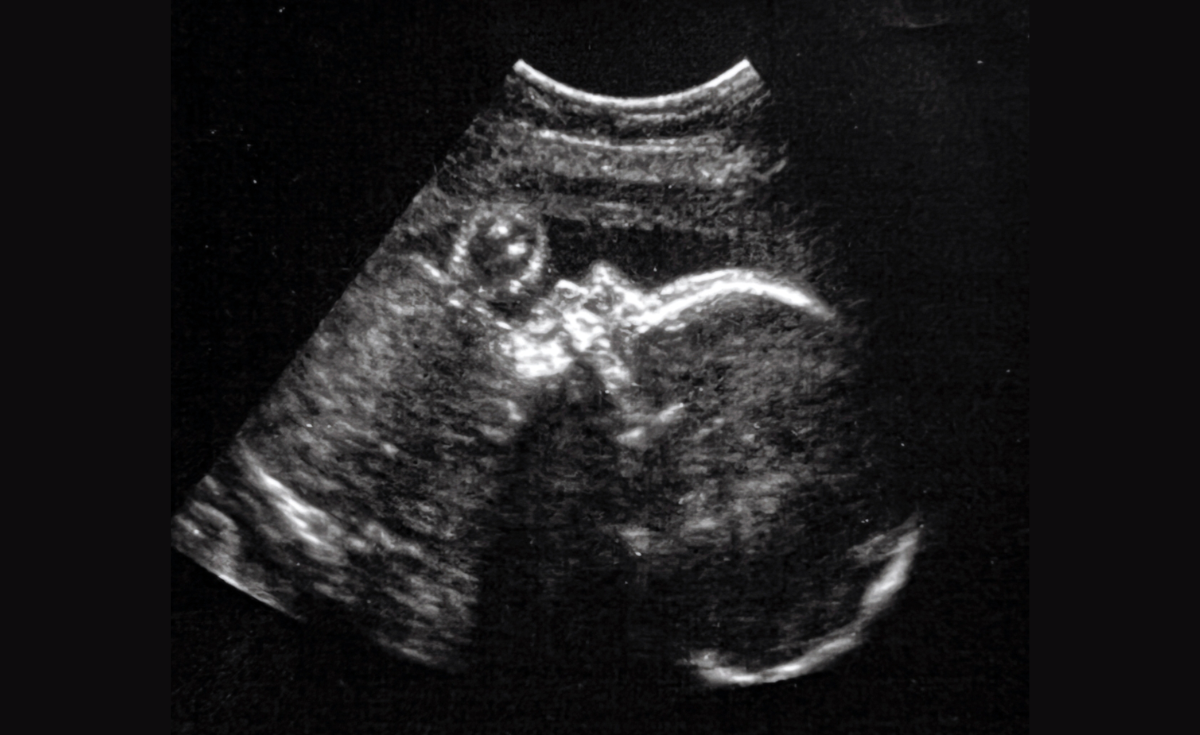 ครั้งแรก ! แพทย์ผ่าตัดสมองตัวอ่อนในครรภ์รักษาอาการหลอดเลือดผิดปกติ ครั้งแรก ! แพทย์ผ่าตัดสมองตัวอ่อนในครรภ์รักษาอาการหลอดเลือดผิดปกติ