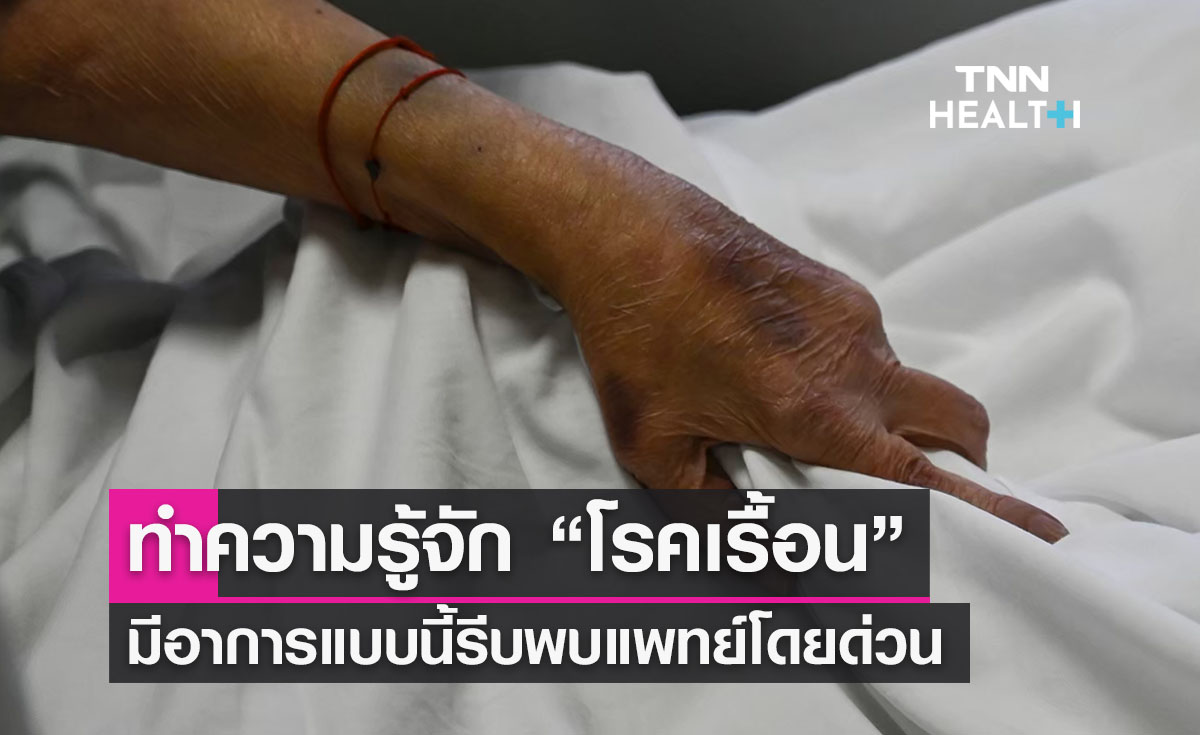 ทำความรู้จัก “โรคเรื้อน” มีอาการแบบนี้รีบพบแพทย์โดยด่วน