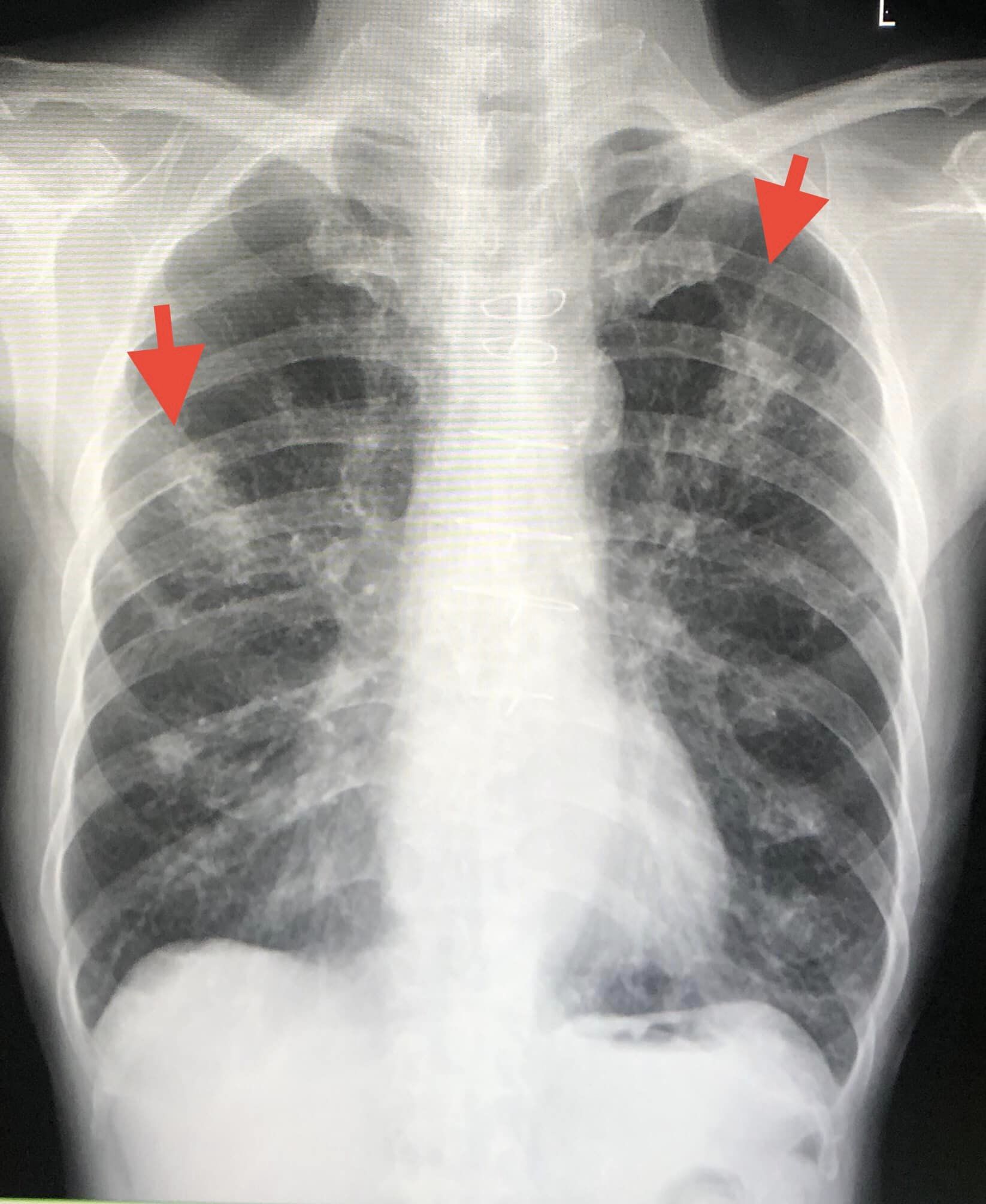 หมอมนูญเผยเคสผู้ป่วย “ปอดติดเชื้อจากราในเมล็ดข้าวโพด” หมอมนูญเผยเคสผู้ป่วย “ปอดติดเชื้อจากราในเมล็ดข้าวโพด”