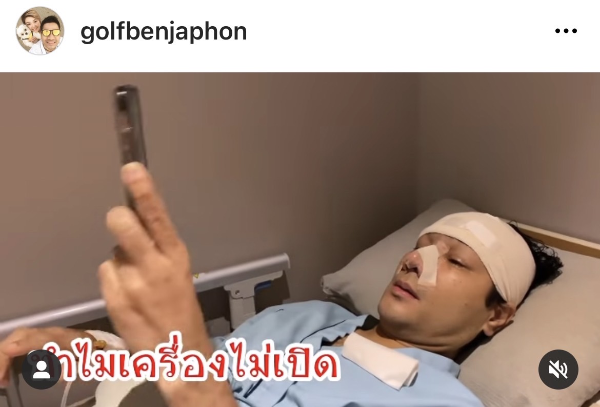 กอล์ฟ เบญจพล อัปเดตหลังเสริมหล่อ ถูกโทรศัพท์แกงหนัก จำหน้าไม่ได้?!  