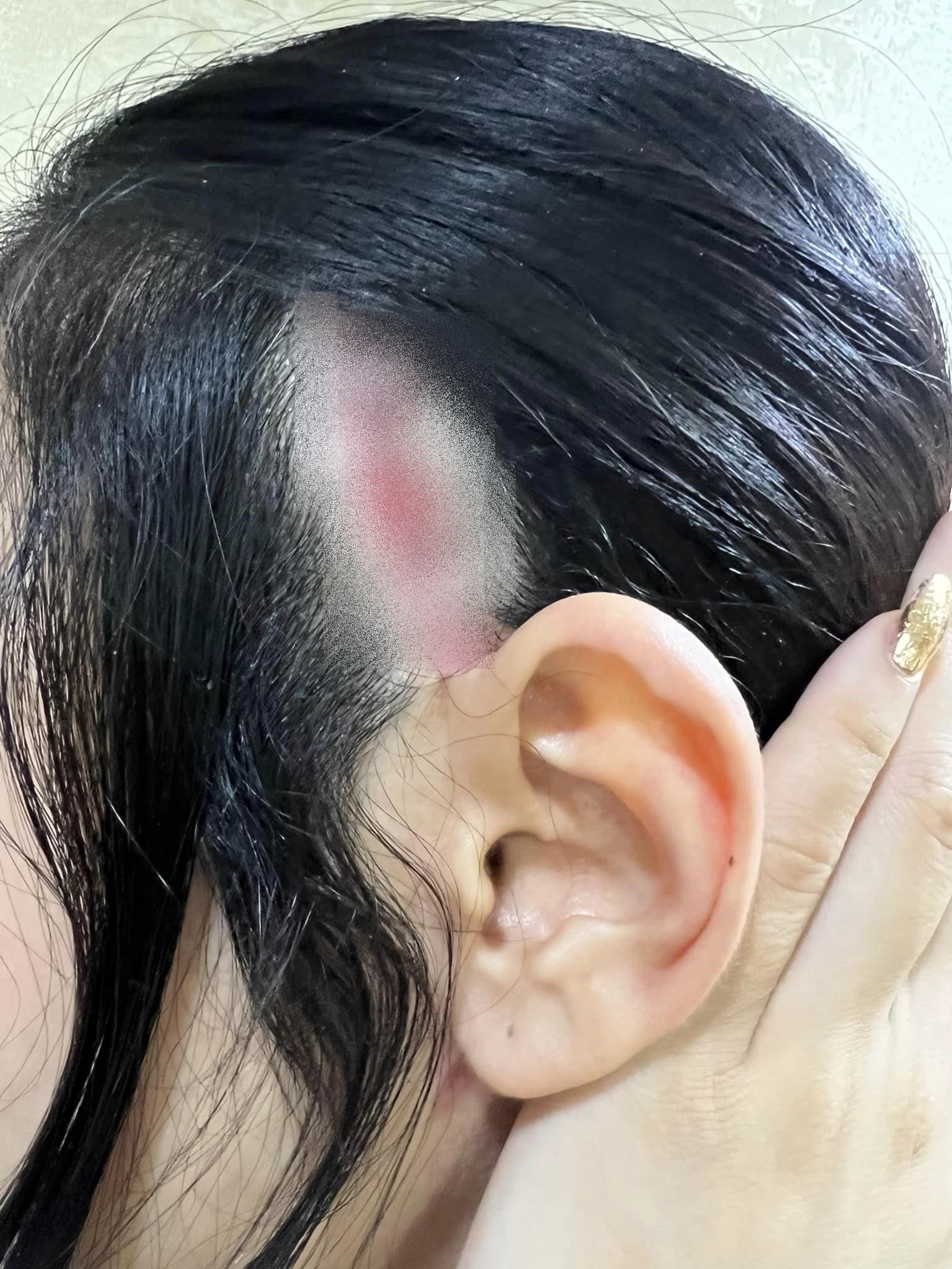 ศัลยกรรมสยอง! น้ำเพชร ฏีญาร์ภา หนังศรีษะเปิด หลังขึ้นเขียงทำสวย