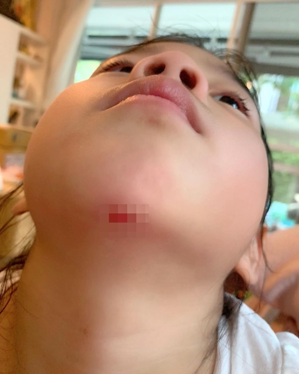 กุ๊บกิ๊บ ใจหล่น!! เป่าเปา ล้มคางแตกเย็บ 4 เข็ม! กุ๊บกิ๊บ ใจหล่น!! เป่าเปา ล้มคางแตกเย็บ 4 เข็ม!