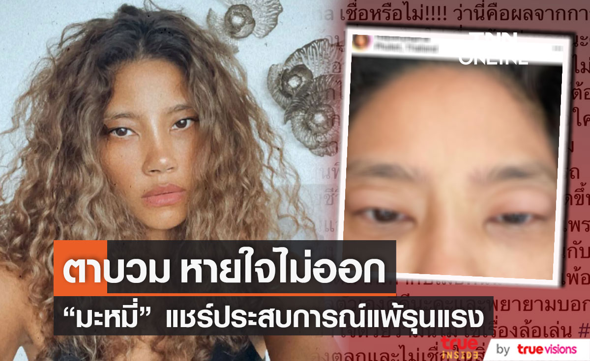 "มะหมี่ นภคปภา" เกิดอาการแพ้น้ำยาซักผ้ารุนแรง ถึงขั้นหายใจไม่ออก ตาบวม (มีคลิป)