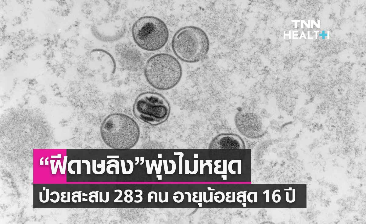 “ฝีดาษลิง”พุ่งไม่หยุด ผู้ป่วยสะสม 283 คน อายุน้อยสุด 16 ปึ 