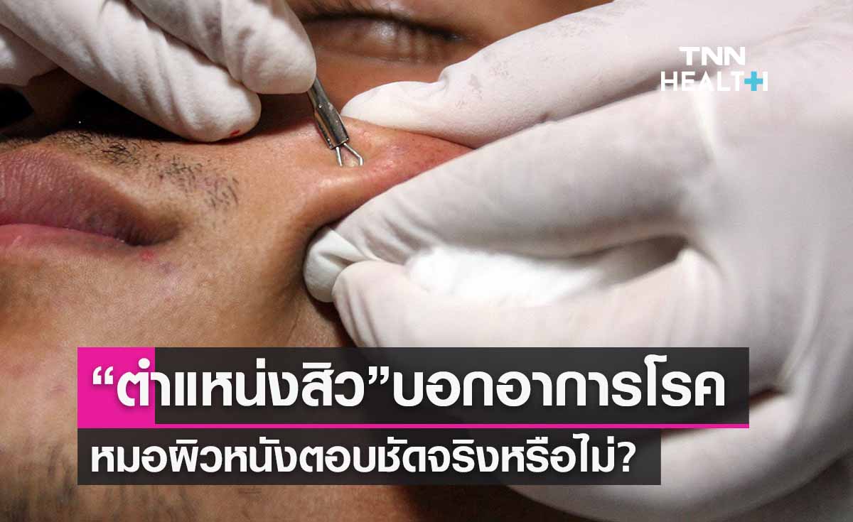 “ตำแหน่งสิว” บอกอาการป่วยของโรคได้ หมอผิวหนังตอบชัดจริงหรือไม่? 
