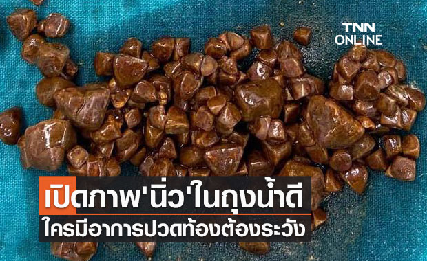 ใครมีอาการปวดท้องต้องระวัง! เปิดภาพ 'นิ่ว' จำนวนมากในถุงน้ำดี 